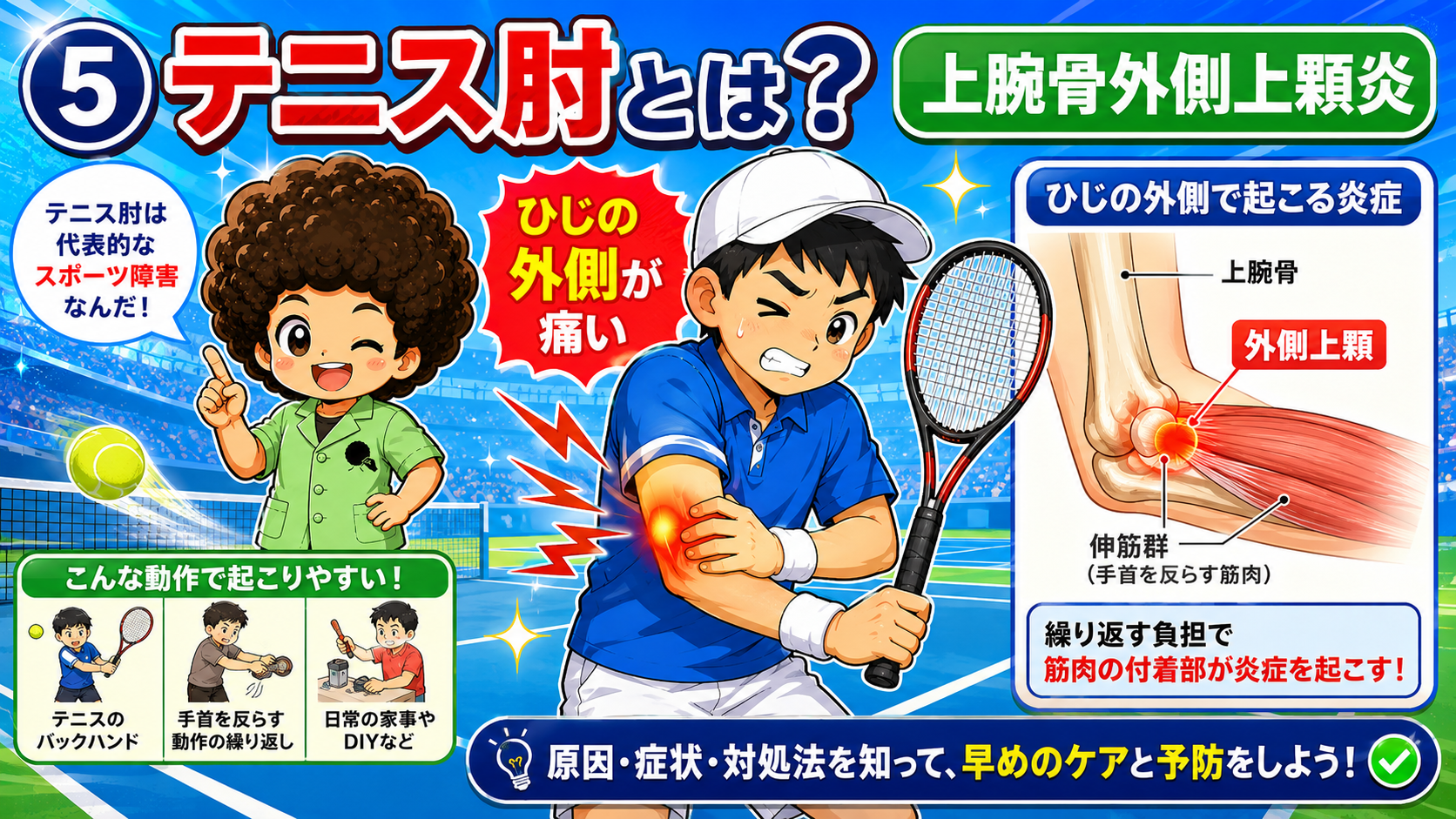 上腕骨外側上顆に付く伸筋群の付着部でくり返す負担により炎症が起こる