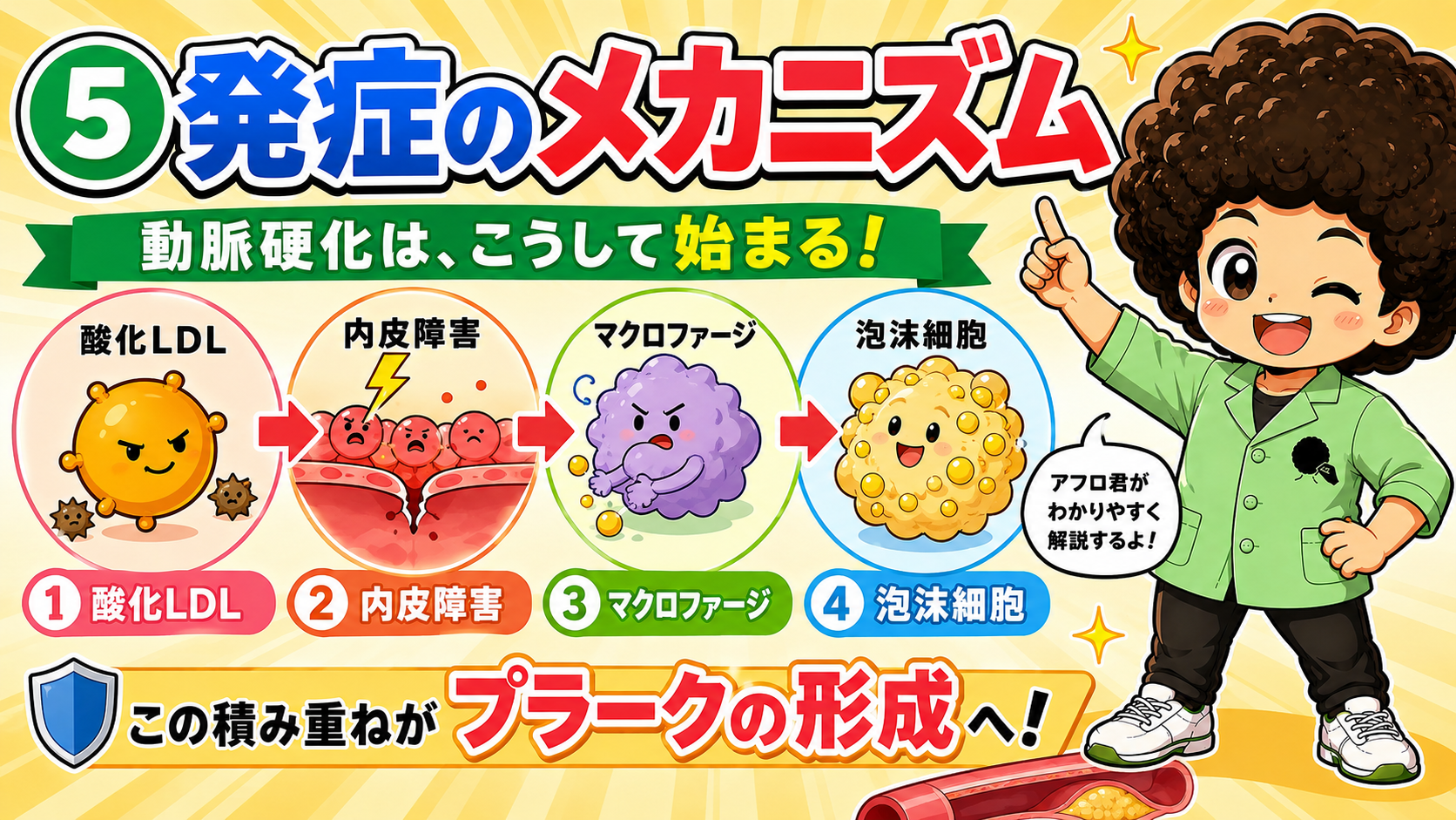 酸化LDL→内皮障害→マクロファージ→泡沫細胞という発症メカニズム