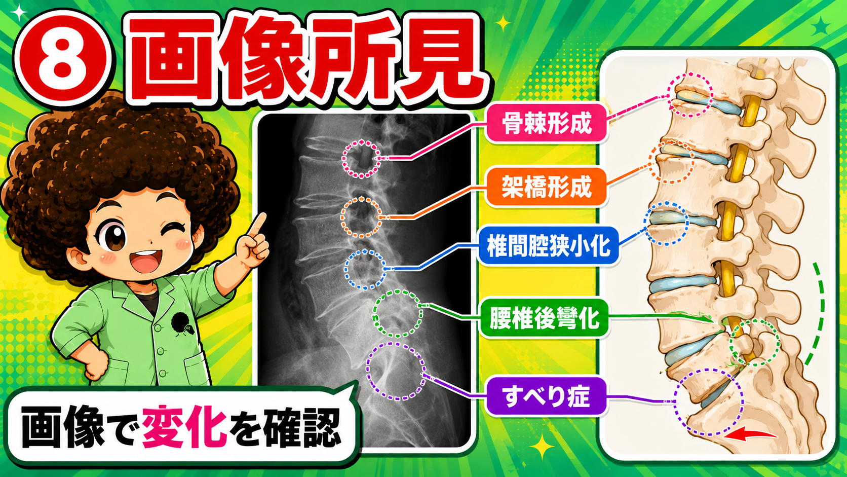 X線でみられる骨棘形成・架橋形成・椎間腔狭小化などの変性所見