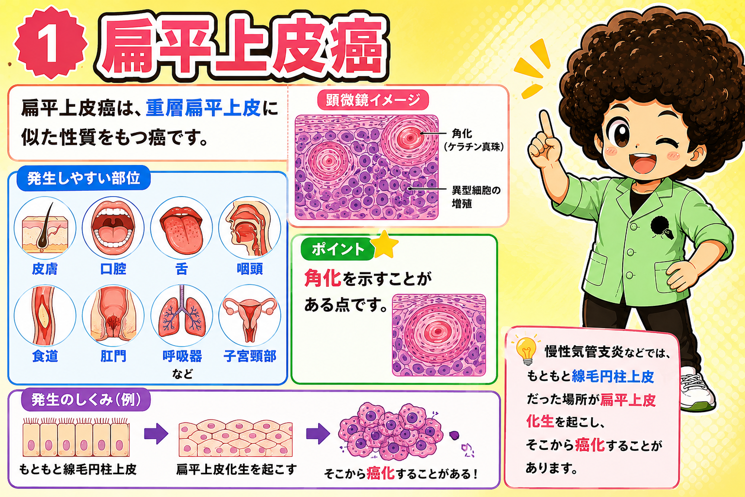 扁平上皮癌は重層扁平上皮に似た性質をもち、角化（ケラチン真珠）を示すことがある