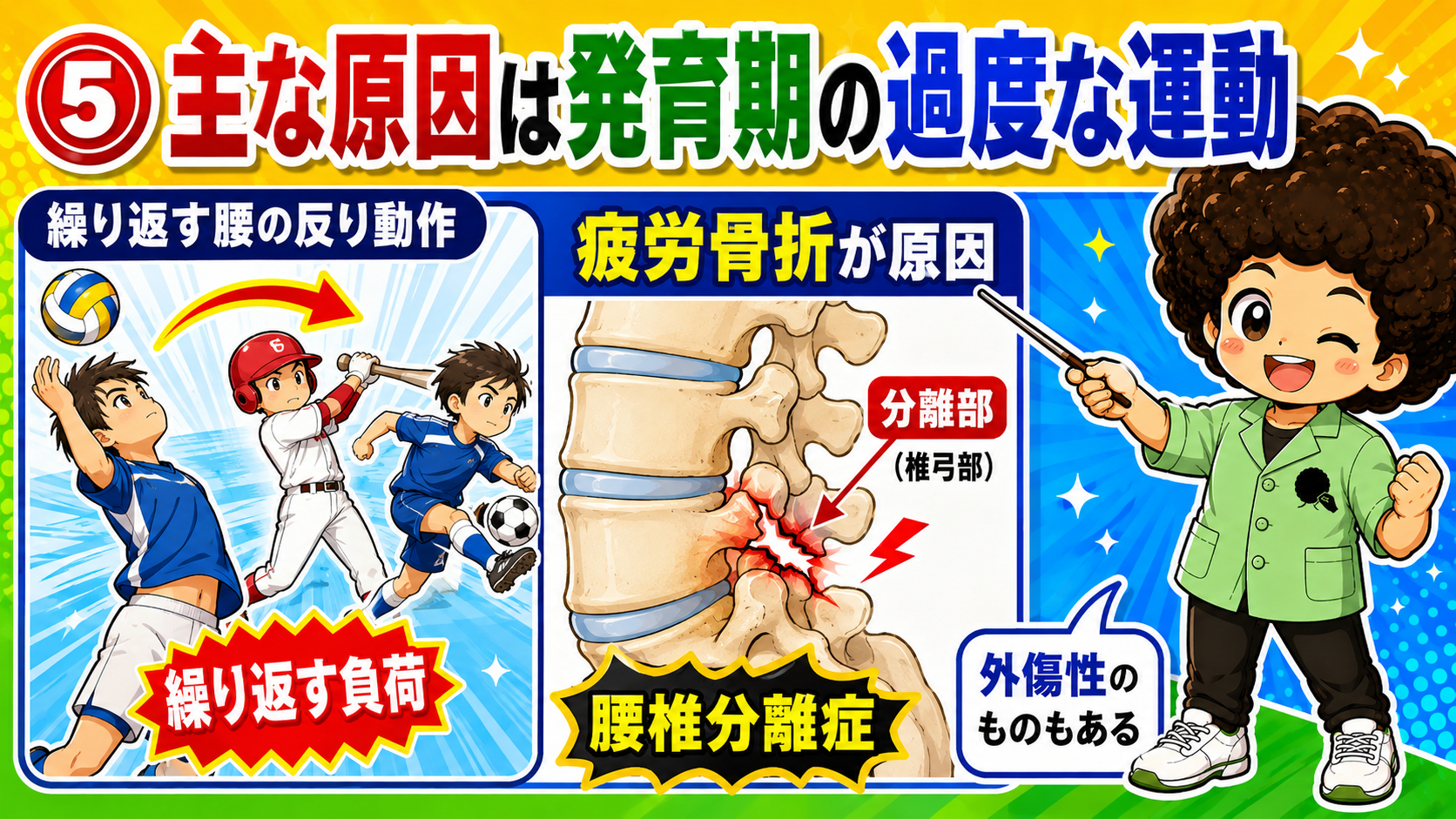 繰り返す反り動作による椎弓部の疲労骨折が分離症の原因