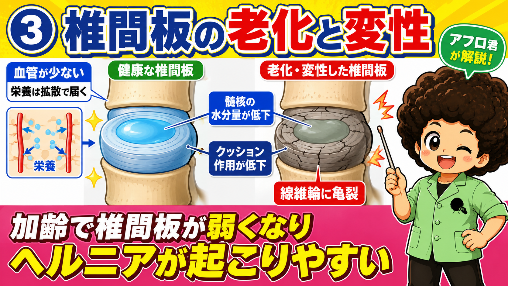 健康な椎間板と、水分低下・亀裂が生じた老化・変性した椎間板の比較
