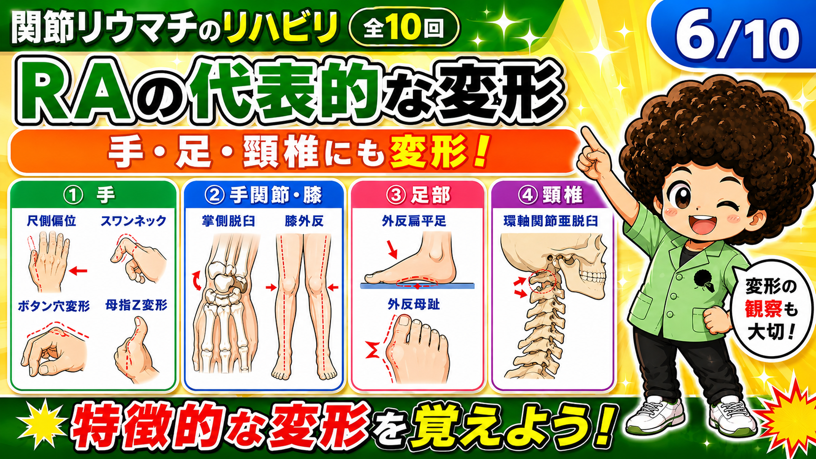RAの代表的変形：手・手関節/膝・足部・頸椎