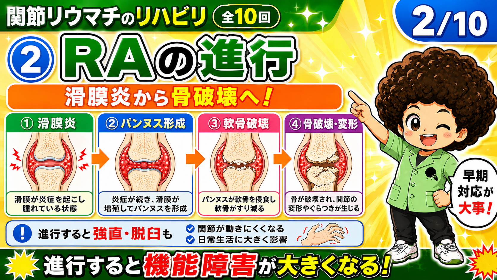 RAの進行：滑膜炎からパンヌス形成・軟骨破壊・骨破壊へ